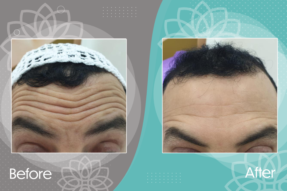 Eliminating wrinkles &amp; expression lines in forehead &amp; around eyes using botox