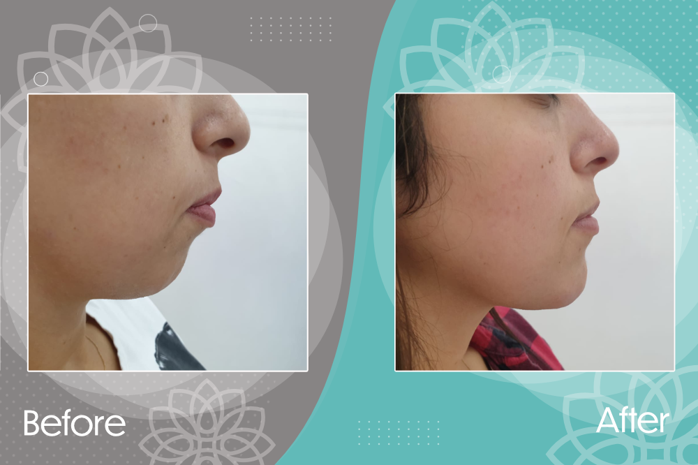 Chin augmentation by filler injection to restore normal facial dimensions