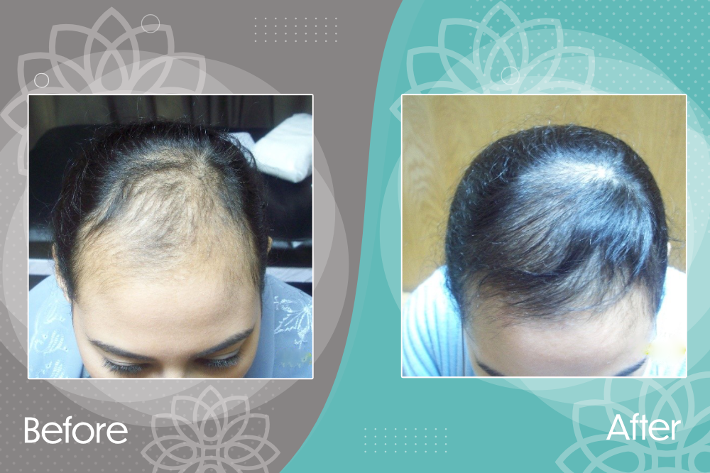 Excellent improvement in a girl with type 3 androgenetic alopecia.