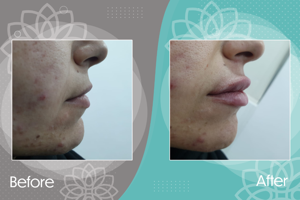 Filler injection to restore lip volume and decrease the distance between the nose and upper lip