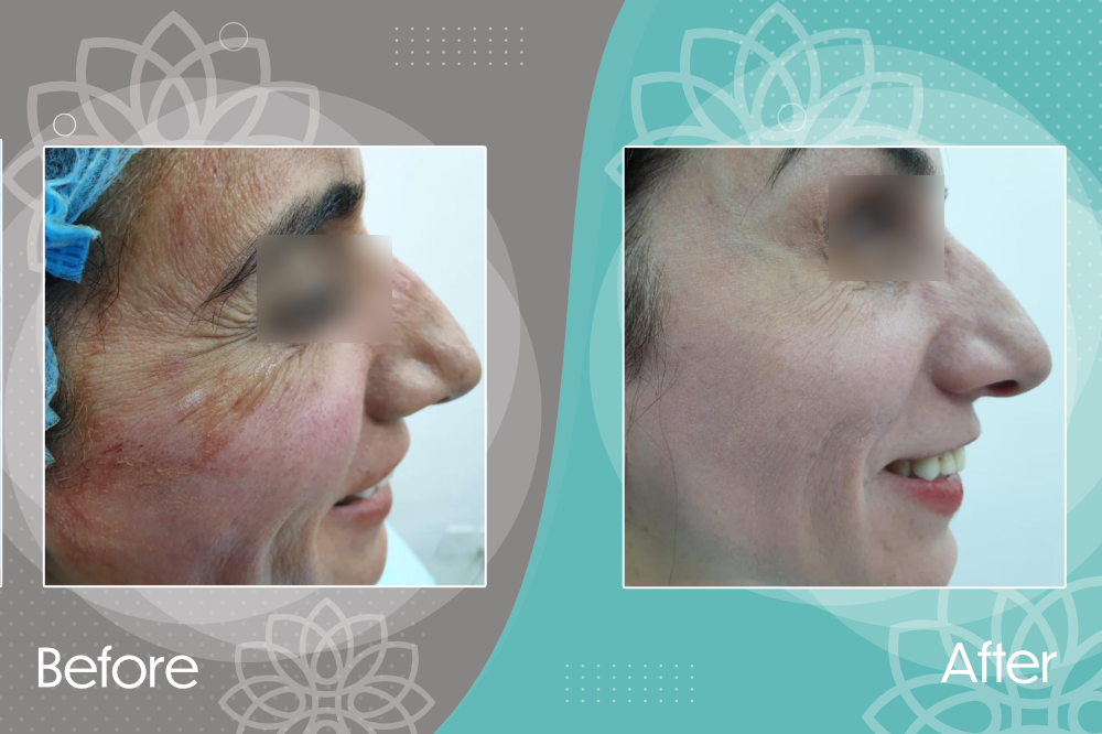 Eliminating crow&apos;s feet by botox injection and treating skin pigmentation by cold peel