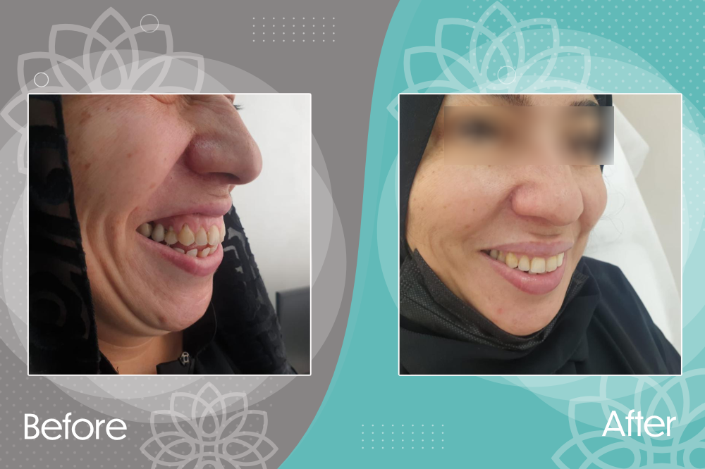Correction of Gummy Smile by Botox Injection.